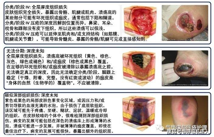 褥疮最新分期及深度了解与治疗策略指南